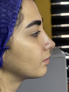 تزریق چربی سقز