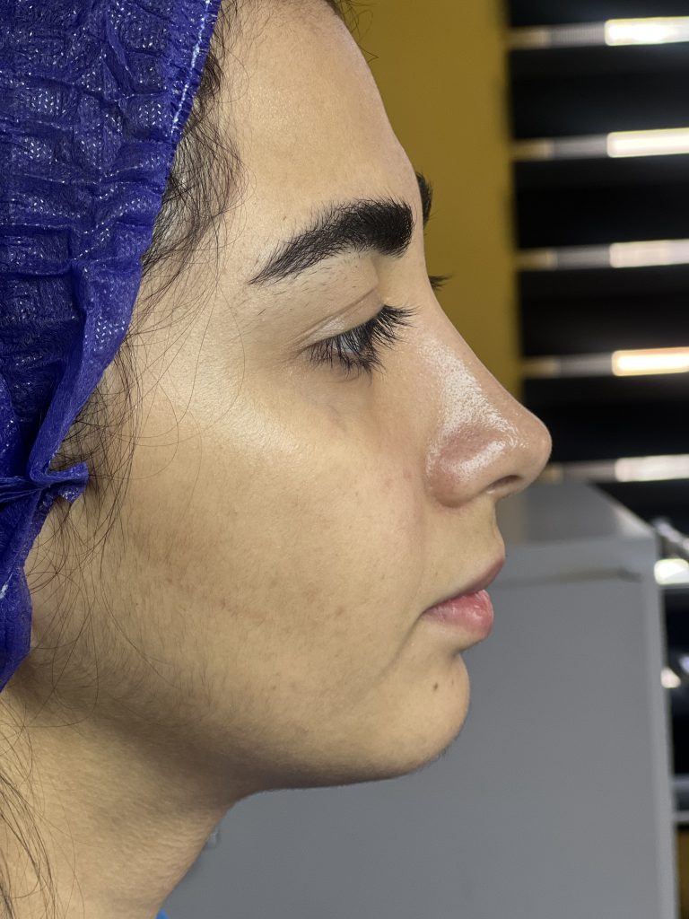 تزریق چربی سقز