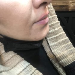ژل لب سقز تزریق ژل لب سقز